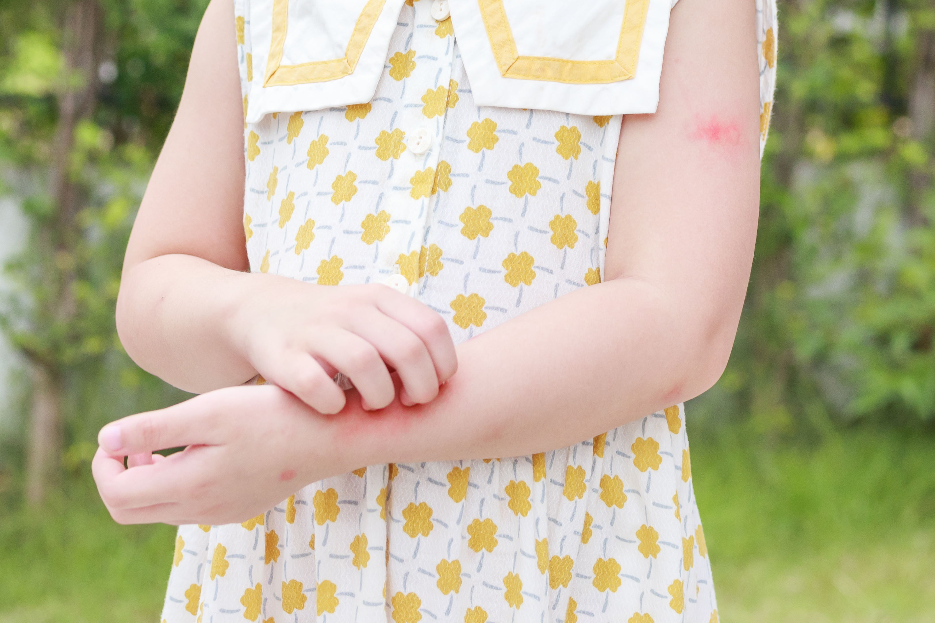 little girl with skin rash